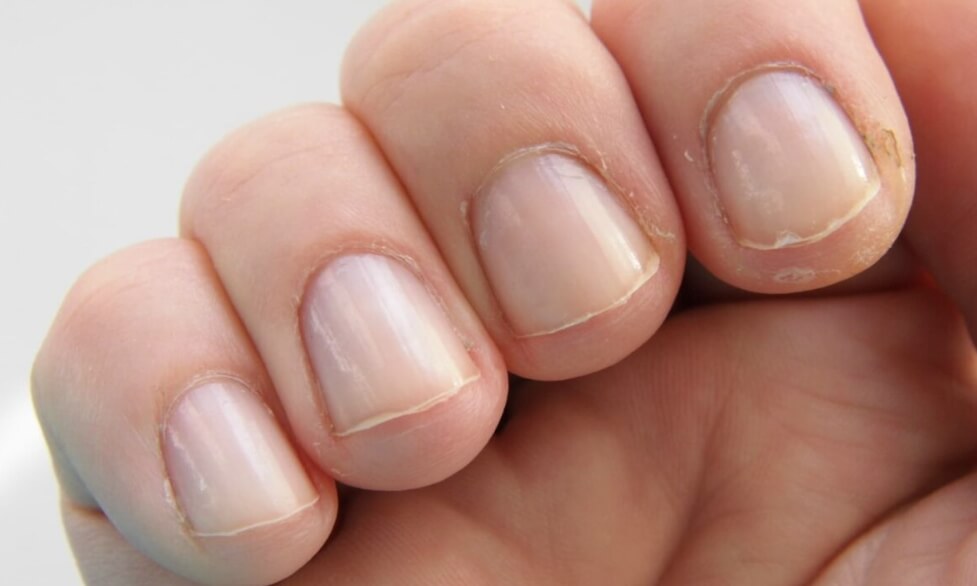 Ногти могут дать сигнал о развитии болезней, но вместо поиска информации в Интернете лучше сразу обратиться к врачу. Фото.
