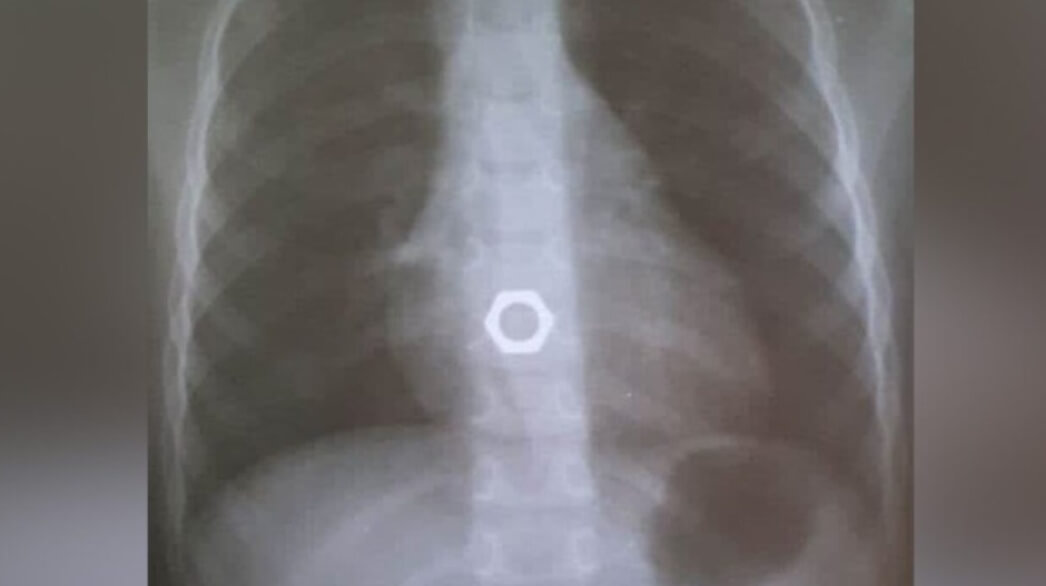 Ожидается, что робот сможет извлекать из организмов инородные предметы. Фото.