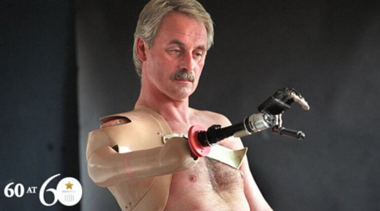Первый человек с современным бионическим протезом. Роберт Кэмпбелл с бионической рукой. Фото.