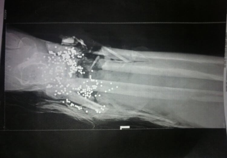 Сначала пулевое ранение не причиняет боли. Рентген простреленной ноги Райана Джерси. Фото.