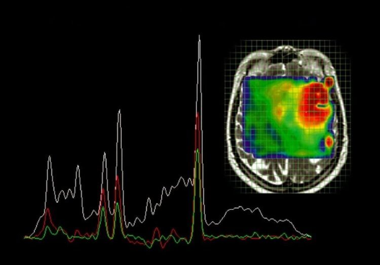 Измерение температуры мозга. Магнитно-резонансная спектроскопия. Фото.