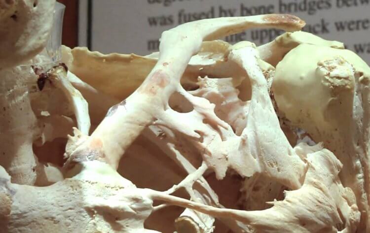 Прогрессирующая фибродисплазия. Скелет человека с фибродисплазией. Фото.