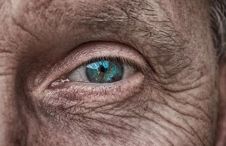 Клещи есть на коже всех людей. Угревые клещи есть на коже лица почти всех пожилых людей. Фото.