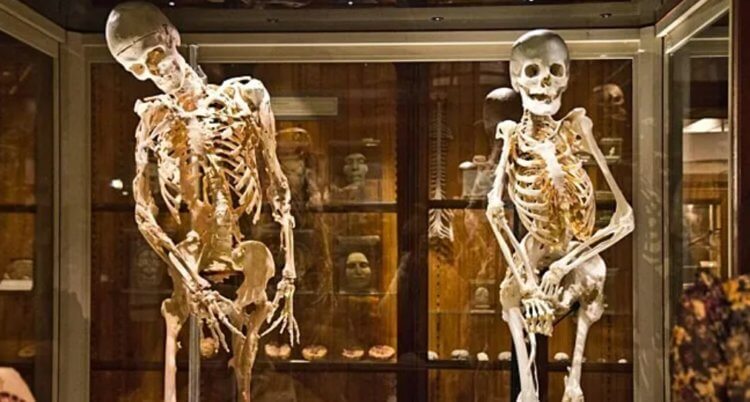 Болезни костей у древних людей. У древних людей иногда развивались болезни костей. Фото.