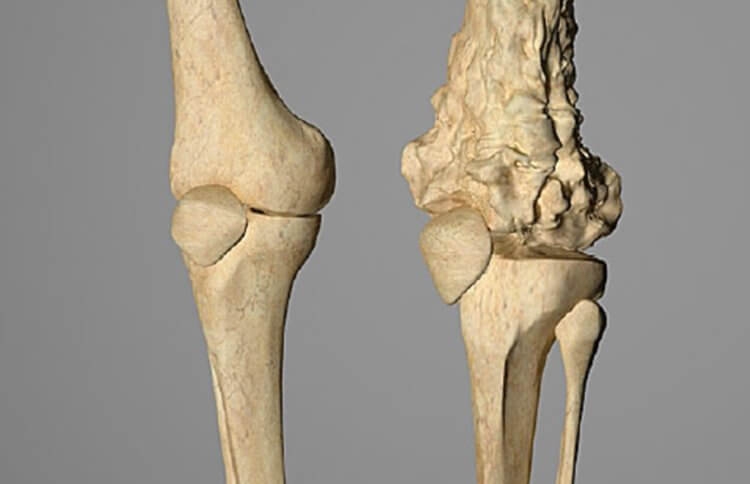 Остеосаркома у предков человека. Здоровая кость и кость с остеосаркомой. Фото.