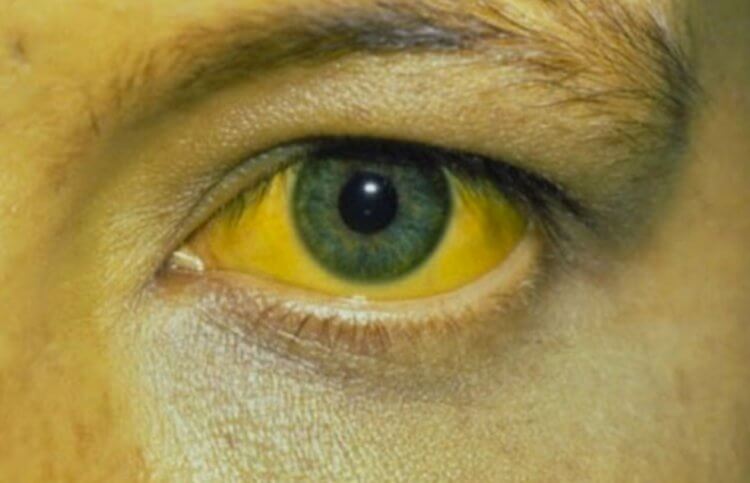 Как гепатит отражается на глазах. При гепатите глаза человека становятся желтыми. Фото.