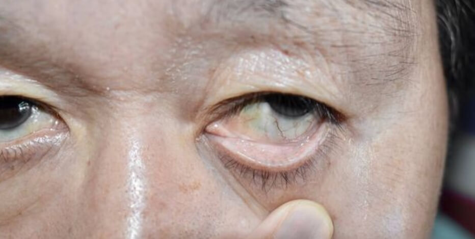 5 болезней, которые можно определить по состоянию глаз