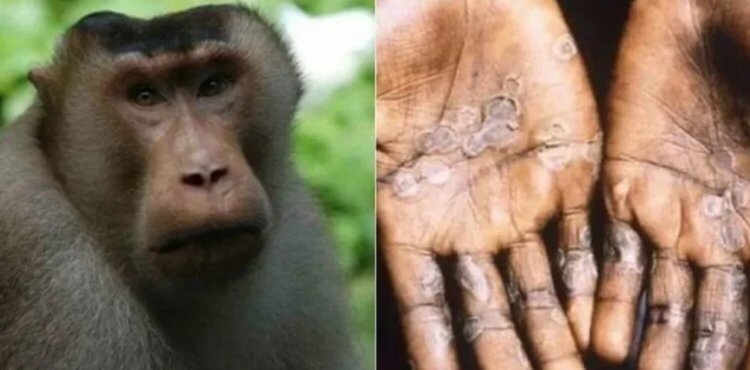 Сколько людей заразились оспой обезьян. Вирус оспы обезьян известен науке уже давно и хорошо изучен. Фото.