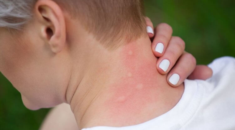 Аллергия на комаров. В некоторых случаях комариные укусы вызывают сильную аллергию. Фото.