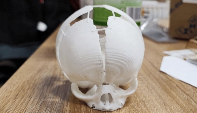 Ученые напечатали на 3D-принтере череп и спасли жизнь ребенку. Фото.
