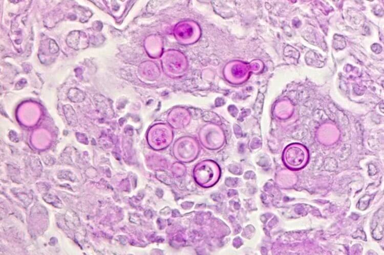 Что такое бластомикоз. Грибок Blastomyces dermatitidis. Фото.