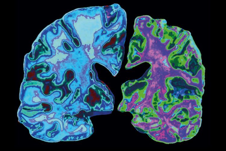 Миф о болезни Альцгеймера. Болезнь Альцгеймера разрушает мозг. Фото.