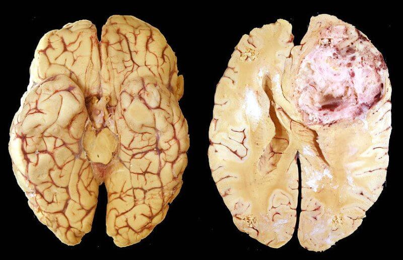 Ученые вылечили опухоль мозга за несколько дней