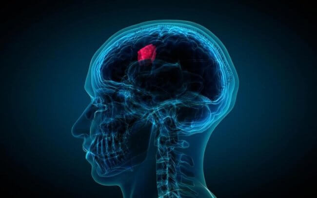 Ученые вылечили опухоль мозга за несколько дней. Фото.