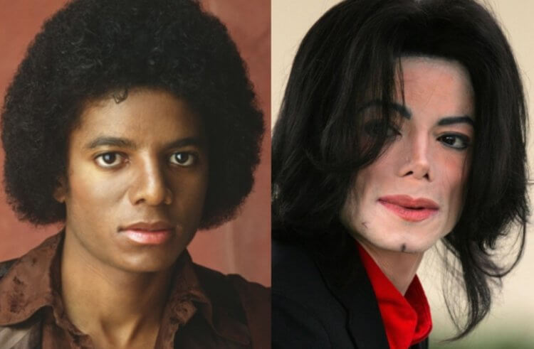 Витилиго — когда у человека меняется цвет кожи. Последствия витилиго у Майкла Джексона. Фото.