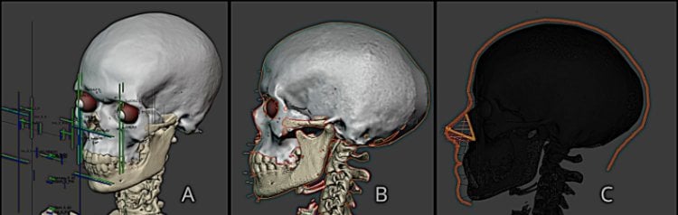 Что показало исследование черепа древнего человека. Для воссоздания нижней челюсти авторы воспользовались данными о челюстях древних и современных людей. Фото.