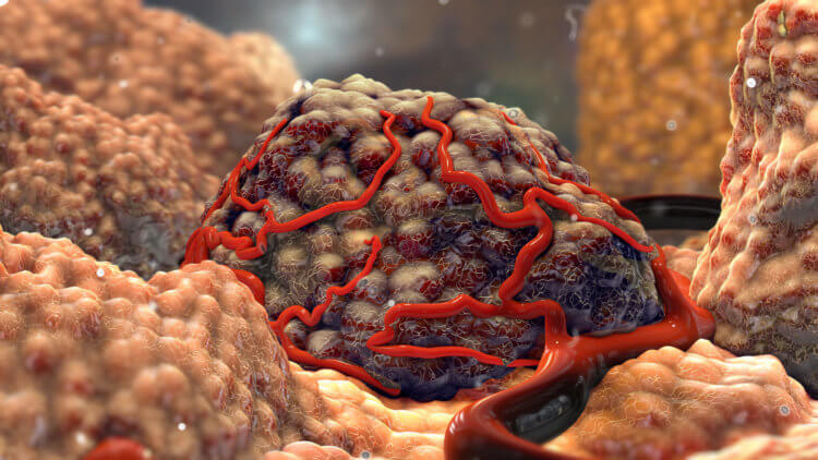 Внутри опухолей живут грибки, которые разносят рак по организму? Ученые обнаружили, что внутри раковых клеток содержатся грибки. Фото.