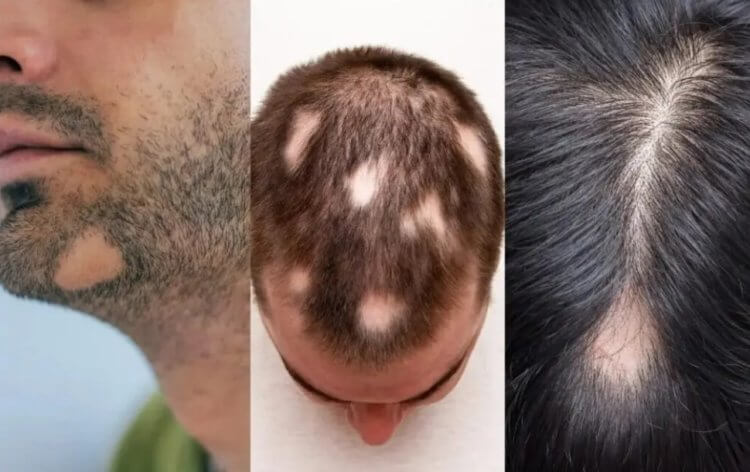 Что нужно знать перед пересадкой волос. Алопеция проявляется по-разному. Фото.