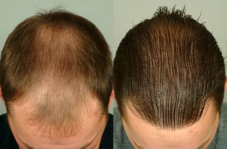 Современные методы пересадки волос. Пример пересадки волос до и после. Фото.