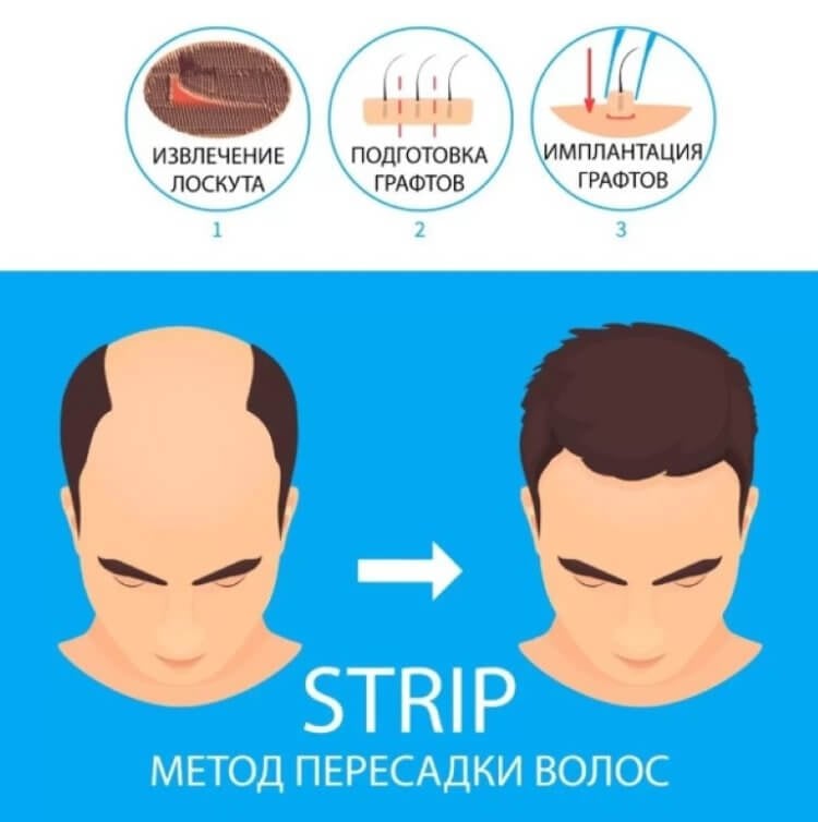 Пересадка волос методом FUT. Наглядное объяснение пересадки волос FUE (также известен как STRIP). Фото.