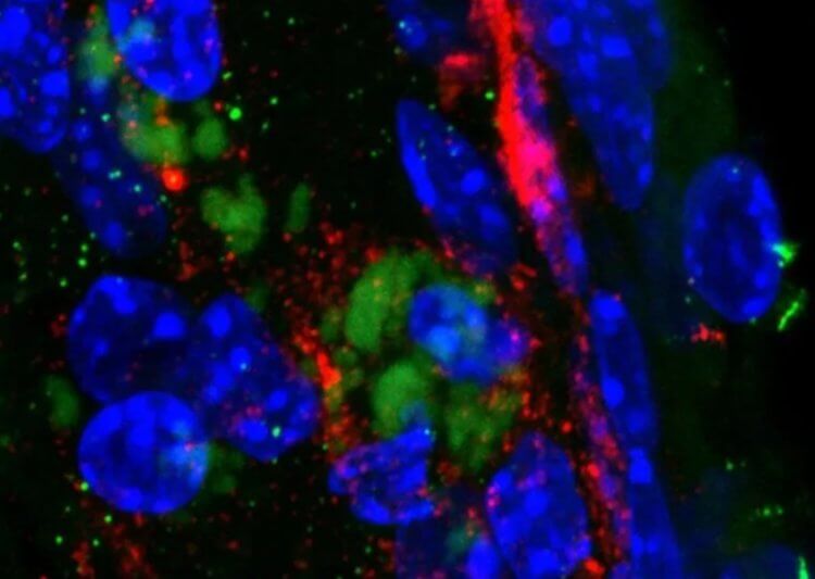 Как бактерии проникают в мозг. Бактерии Chlamydia pneumoniae (зеленые) в головном мозге мыши, окруженные бета-амилоидным белком (красный). Фото.