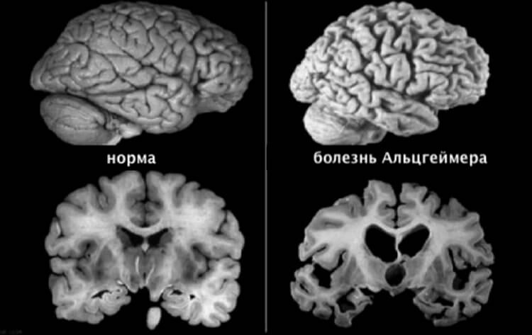 Из-за чего возникает болезнь Альцгеймера. Здоровый мозг, и пораженный болезнью Альцгеймера. Фото.