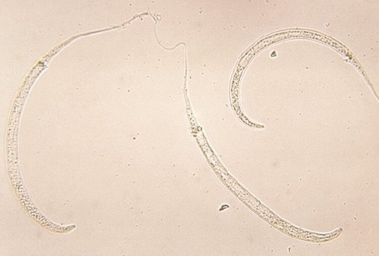 Дракункулез — болезнь, вызываемая личинками ришты. Паразиты Dracunculus medinensis. Фото.