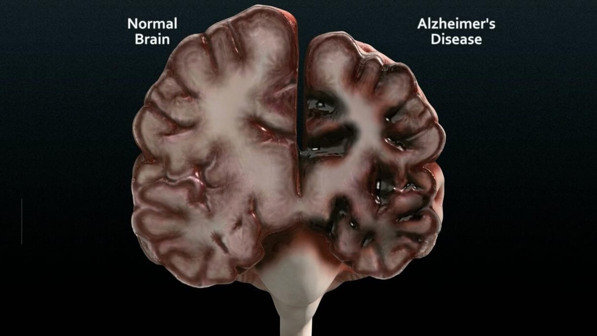 Профилактика болезни Альцгеймера. Болезнь Альцгеймера разрушает наш самый главный орган — головной мозг. Фото.