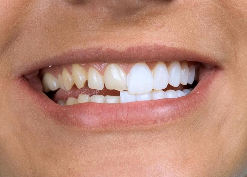 Побочный эффект от антибиотиков. Чтобы скрыть черные зубы, приходится использовать виниры. Фото.