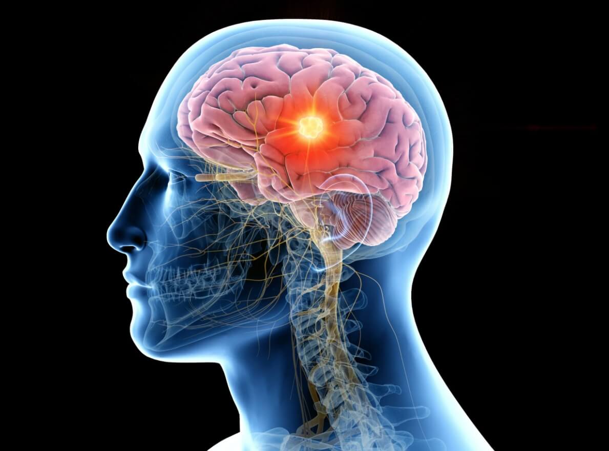 Чем мигрень отличается от обычной головной боли. Когда человек говорит, что у него болит голова, речь не идет о головном мозге — дело в сосудах. Фото.