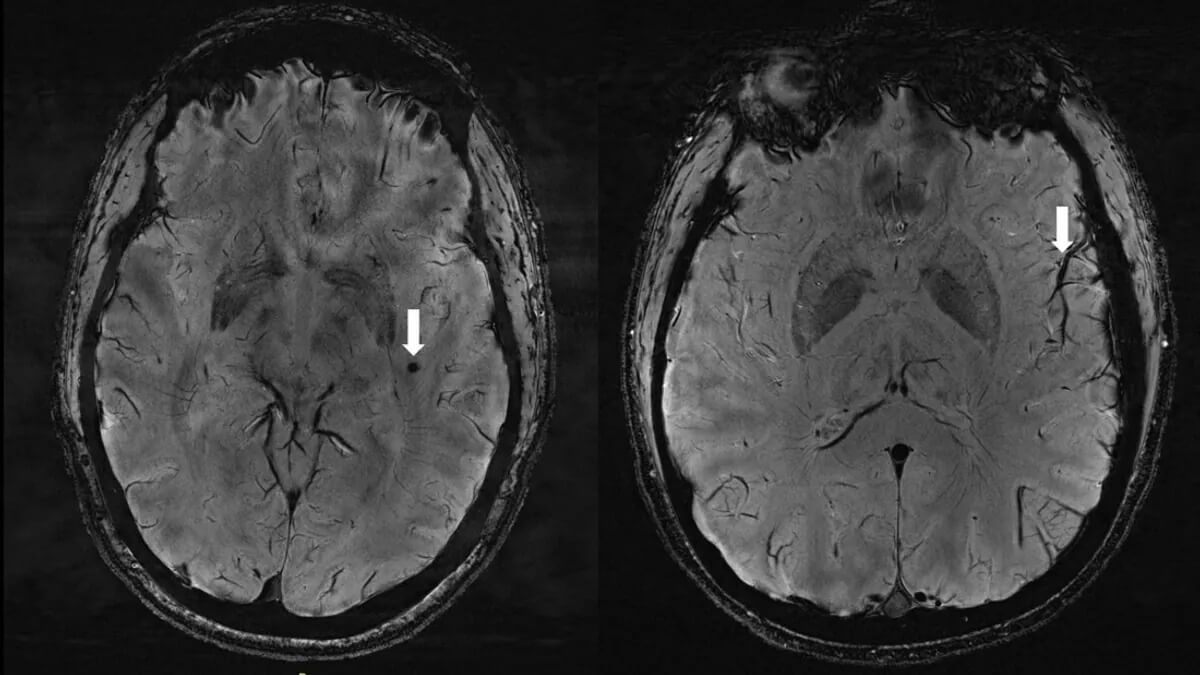 Из-за чего начинается мигрень — новое открытие. Стрелка слева указывает на микрокровоизлияние в мозг при мигрени с аурой. Стрелка справа демонстрирует асимметрию внешнего вида сосудов. Фото.