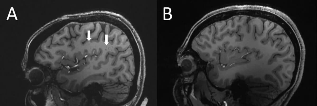 Из-за чего начинается мигрень — новое открытие. Стрелки указывают на расширенные периваскулярные пространства полуовального центра в головном мозге человека с хронической мигренью. На изображении B показан головной мозг здорового человека, у которого нет таких аномалий. Фото.