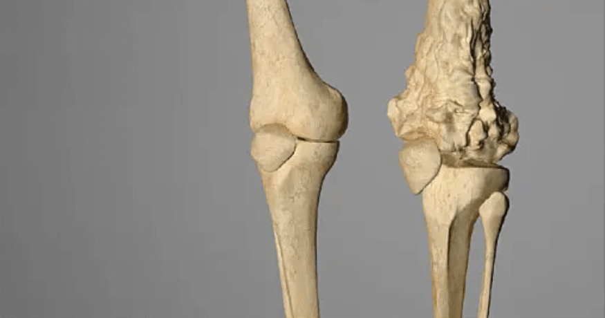 Медицинский диагноз древней амфибии. Остеосаркома — самый распространенный вид рака костей у людей. Фото.