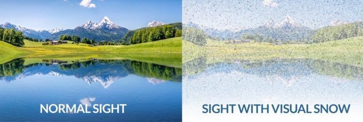 Симптомы визуального снега в глазах. Сравнение нормального зрения и визуального снега. Фото.