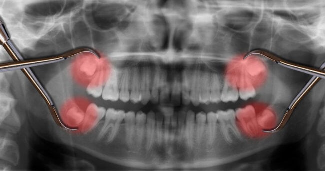 Нужно ли удалять зубы мудрости? Метод удаления зуба врач выбирает в зависимости от того, с какой проблемой вы к нему обратились. Фото.