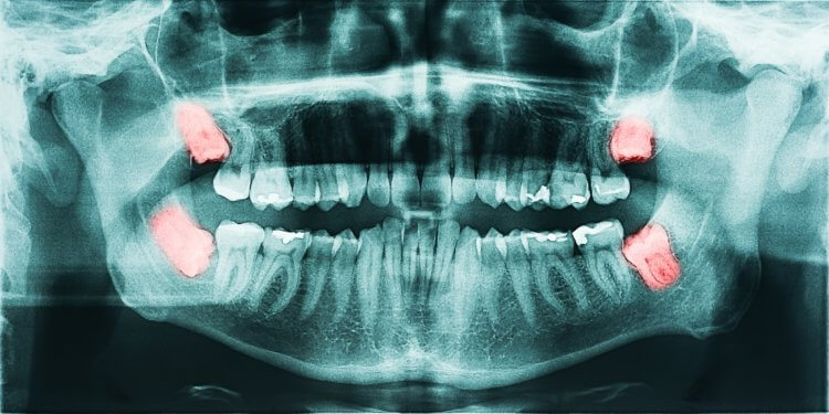 Зачем нужны зубы мудрости и надо ли их удалять? Зачем нужны зубы мудрости, если они не являются участниками пережевывания пищи? Фото.