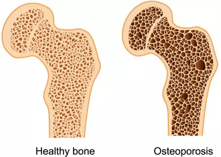 Плохой воздух вызывает риск перелома костей? Сравнение здоровой кости и пораженной остеопорозом. Фото.