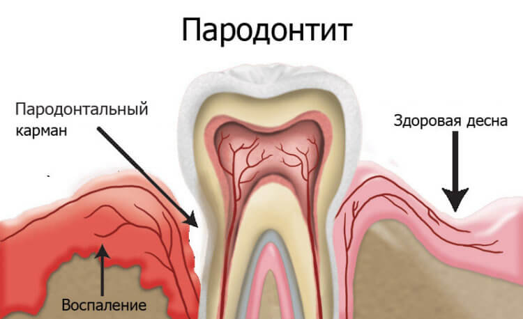 Пародонтит — что это такое? Пародонтит — заболевание тканей, окружающих зуб. Фото.