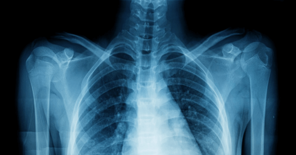 Плохой воздух вызывает риск перелома костей? Загрязненный воздух приводит к уменьшению костной массы и, как следствие, хрупкости костей. Фото.