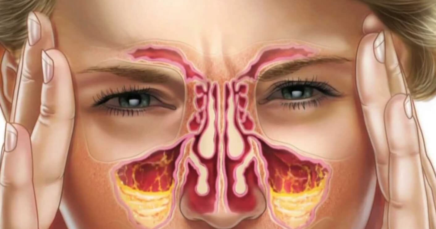 Причины заложенности носа. Во время насморка или аллергической реакции, у людей воспаляются носовые пазухи. Фото.