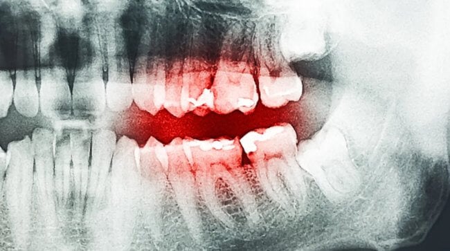 Стоматологи объяснили, почему в 1800-е годы у некоторых людей взрывались зубы. Фото.