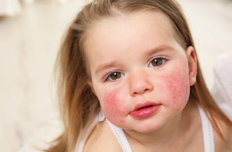 Признаки пищевой аллергии. При возникновении пищевой аллергии у детей часто краснеет кожа. Фото.