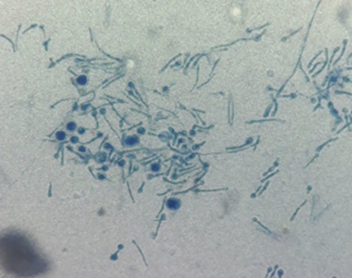 Новая грибковая инфекция человека. Окрашенный грибок Chondrostereum purpureum под микроскопом. Фото.