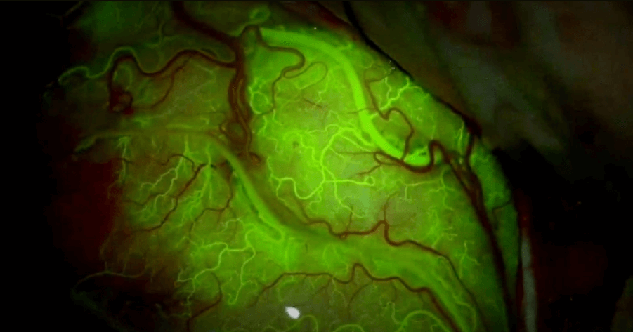 Есть ли опасность от ультразвуковой терапии рака. Флуоресцентный краситель показал высокую эффективность ультразвукового метода доставки препаратов к мозгу. Фото.