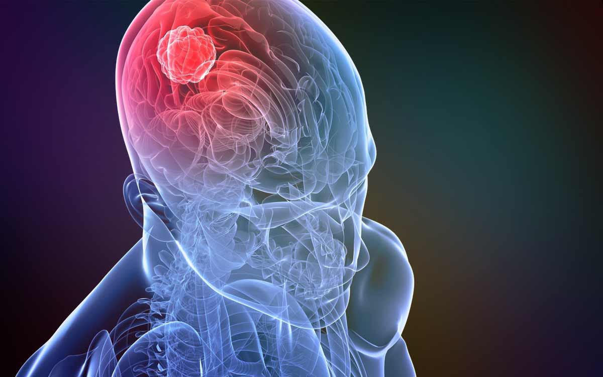 Рак мозга можно лечить при помощи звуковых волн