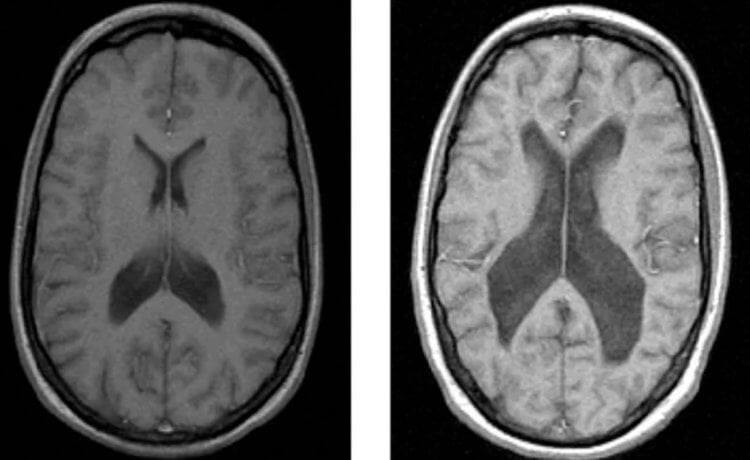 Как психические расстройства влияют на мозг. Мозг здорового человека (слева) и мозг человека с шизофренией (справа). Фото.