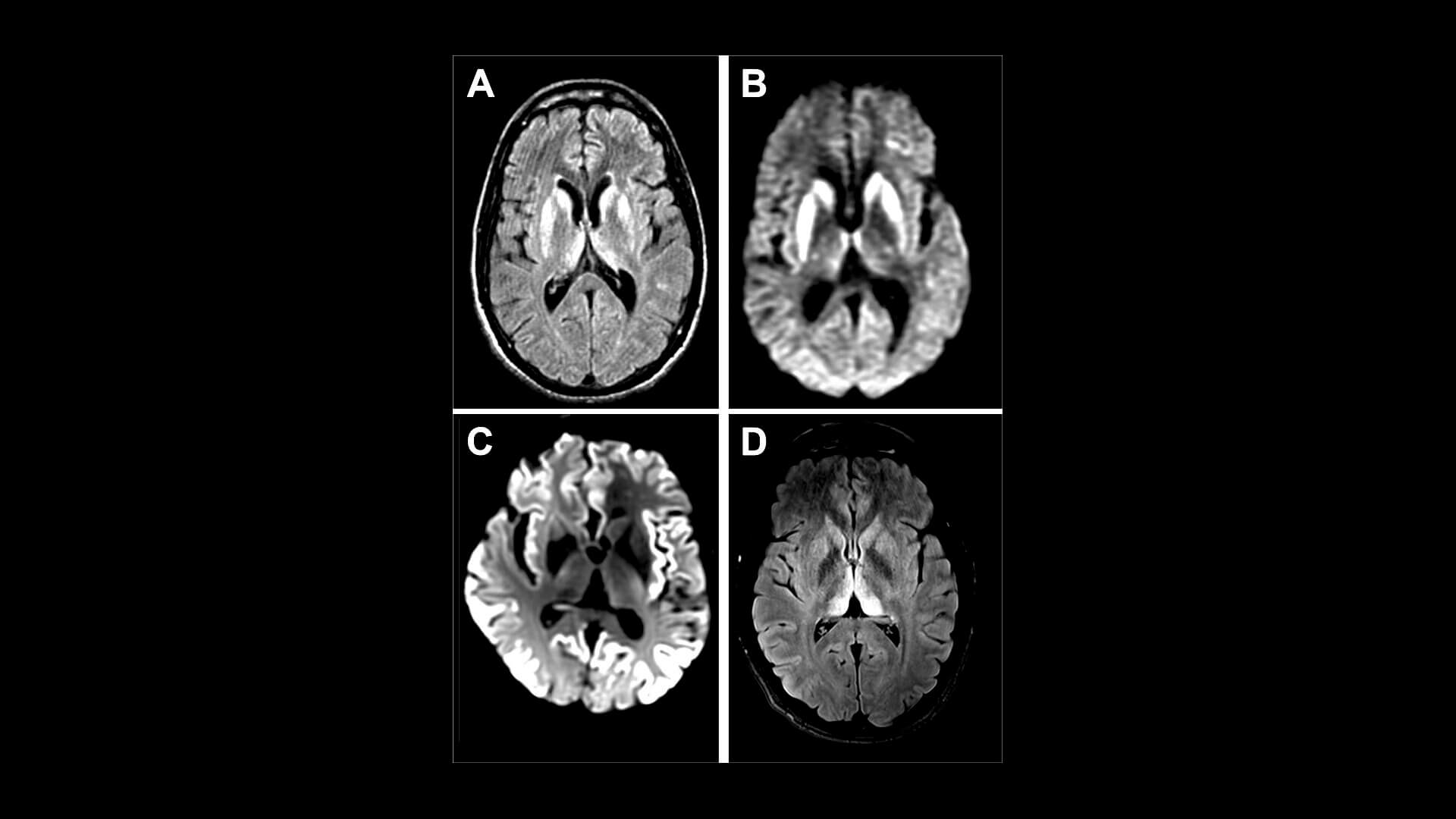 Губчатые энцефалопатии и COVID-19. Изменения в головном мозге во время БКЯ. Фото.