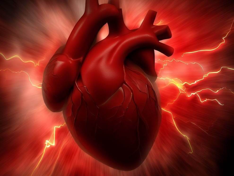 Что такое сердечный приступ. Если коротко, сердечный приступ происходит при недостаточном кровоснабжении сердечной мышцы. Фото.