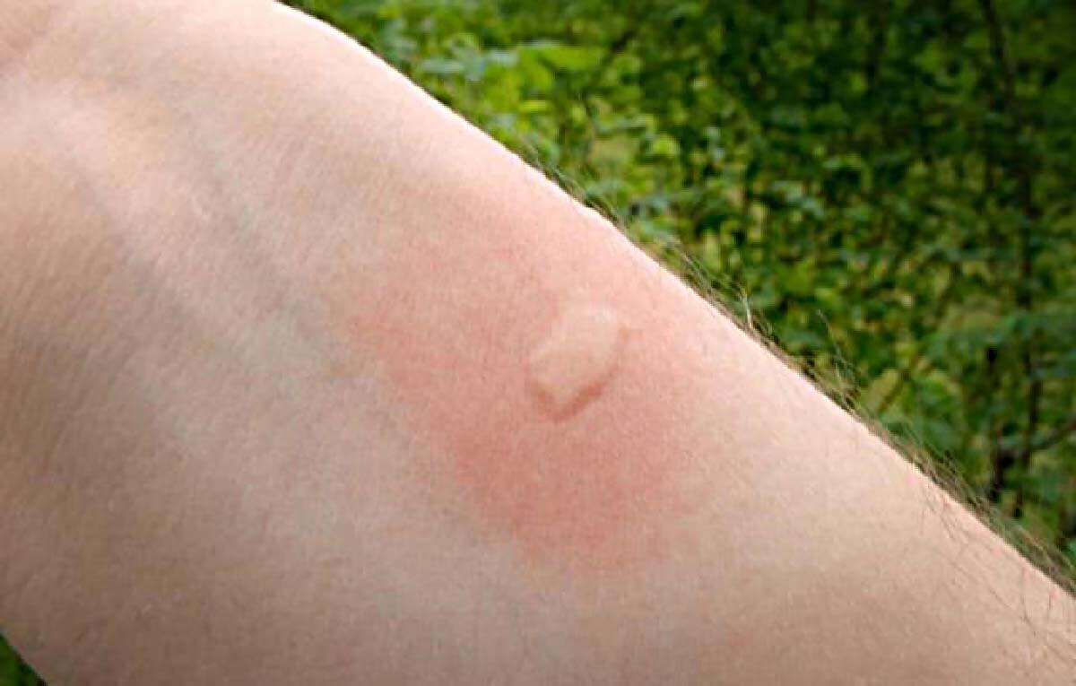 Почему чешется комариный укус. Зуд, отек и покраснение — это реакция иммунной системы на слюну комара. Фото.