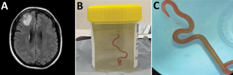 Необычный червь в мозге человека. Червь, которого извлекли из мозга 64-летней австралийки. Фото.